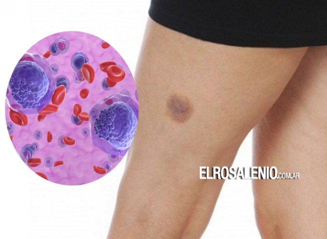 En Argentina, se diagnostican cerca de 1.200 nuevos casos de leucemia mieloide aguda por año